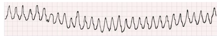 <p>What abnormal automaticity does this EKG show? </p>