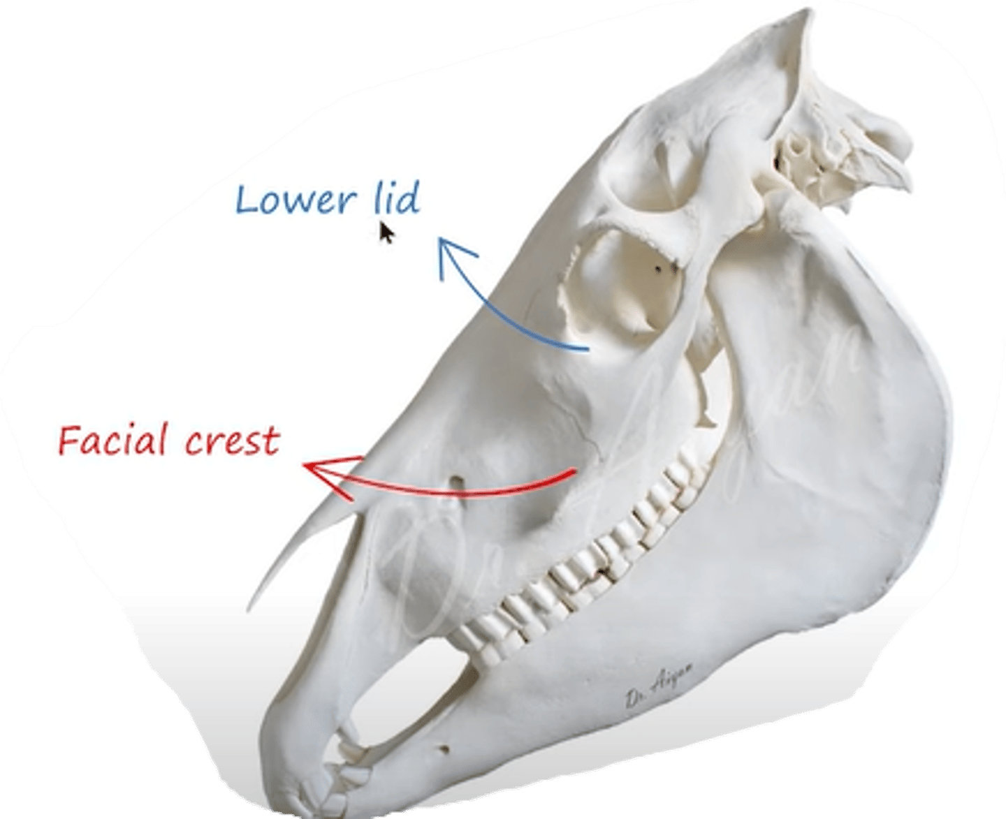 <p>what muscle extends from crista facialis and inserts to the lower lid of eye?</p>