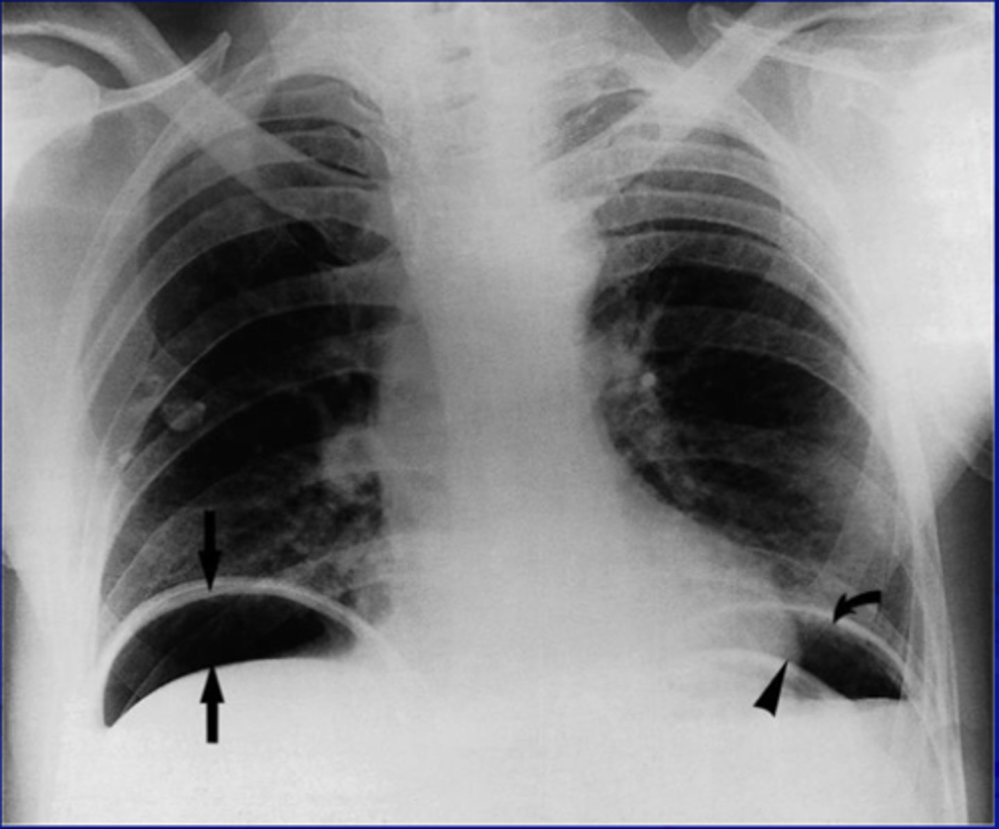 <p>pneumoperitoneum</p>