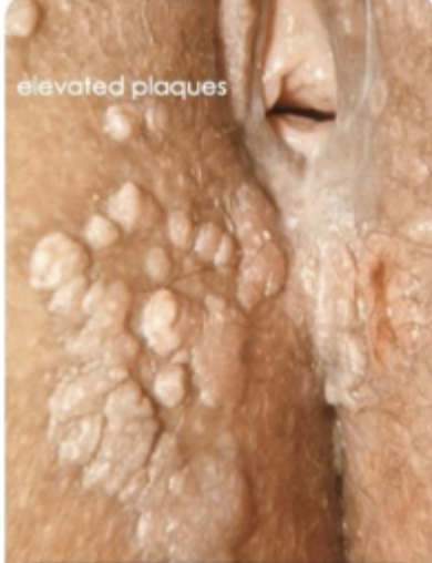 <p>Secondary syphilis (6 weeks to 6 months later) is characterized by</p>