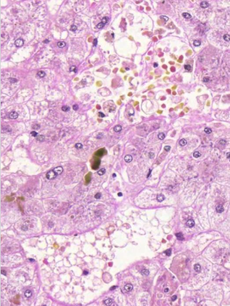 <p>mitä on hepatosyyttien välissä? (vinkki: maksaskirroosi)</p>