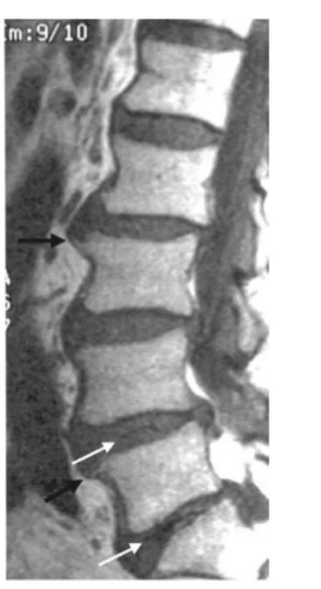 <p>osteophyte formation and disc thinning/collapse</p>