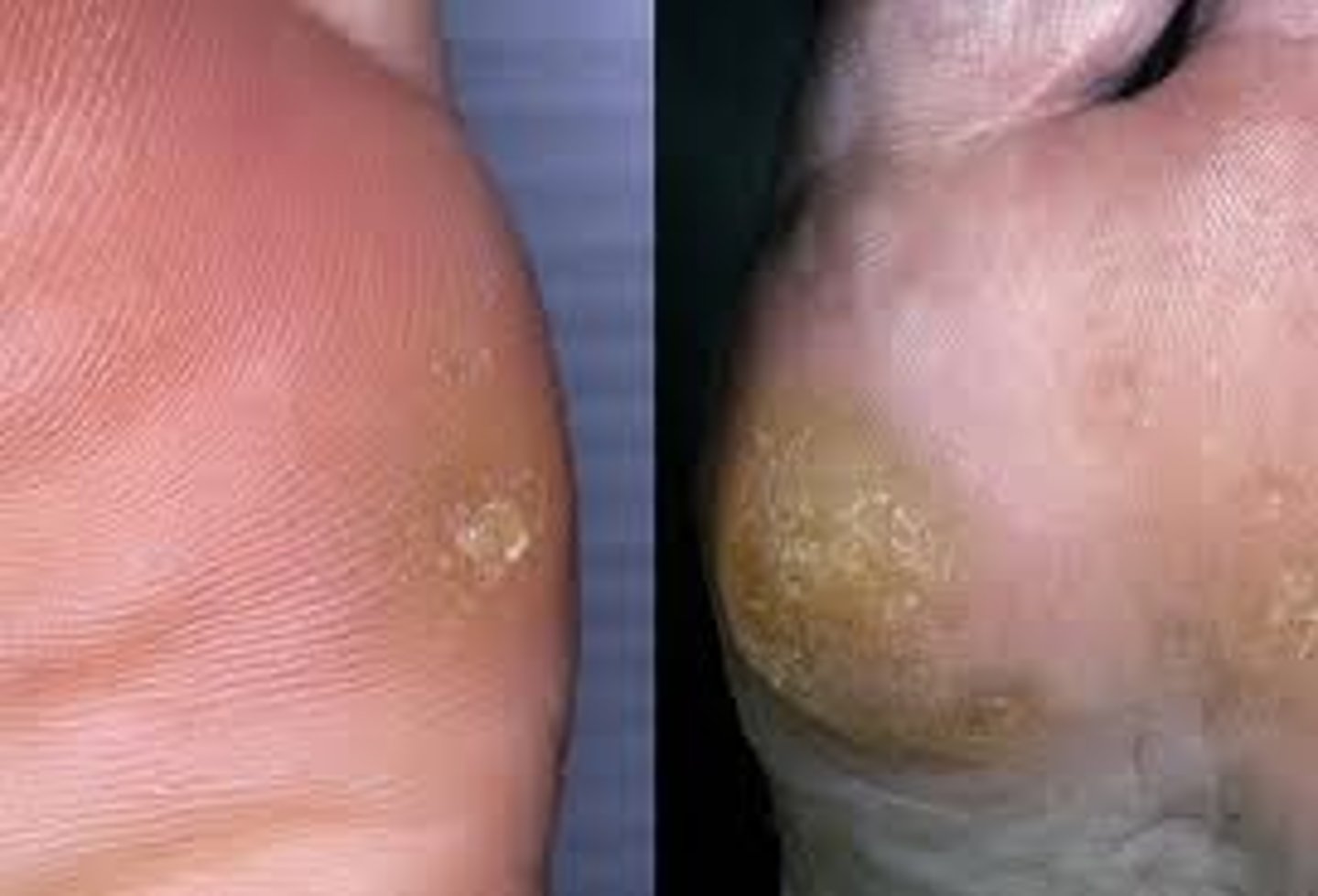 <p>Keratinized conical masses on the toes,</p><p>thickening of soft tissue</p><p>develop on the dorsum over bony prominence from prolonged pressure from shoes</p>