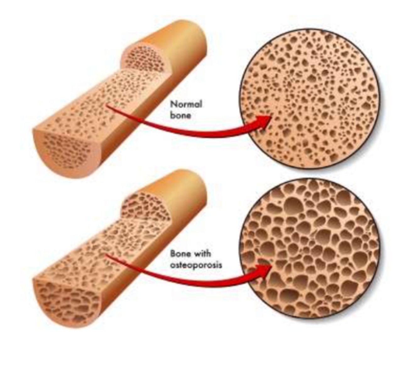 <p>Sjukdom som ger en minskad benmassa orsakad av en obalans som lutar mot resorption</p>