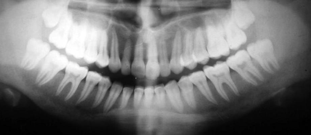 <p>LOSS of <strong>trabecular bone pattern</strong> and l<strong>amina dura </strong></p>