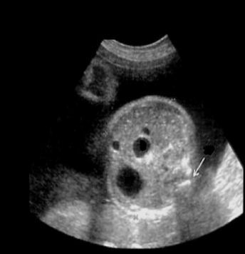 <p>all could cause this expect</p><p>a) anal atresia</p><p>b) esophageal atresia</p><p>c) duodenal atresia</p><p>d) mesenteric mass</p>