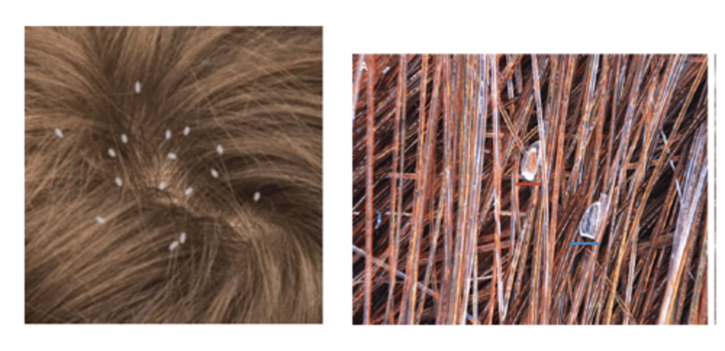 <p>Live louse on scalp (2-3mm, moves quickly) - nits (eggs) alone don’t confirm active infestation</p>