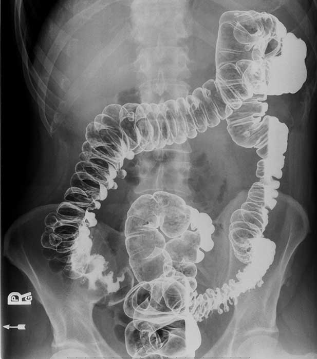 <p>What percentage of people over 60 have diverticula?</p>
