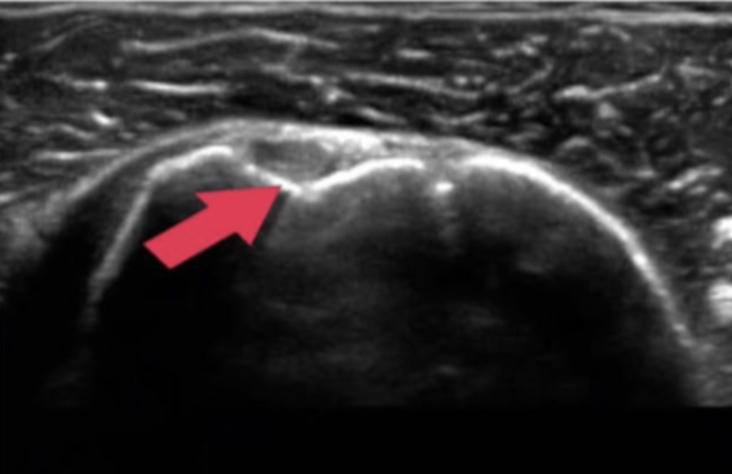 <p>what type of imaging is shown here?</p><p>a. fluoroscopy</p><p>b. ultrasound</p><p>c. bone scan</p><p>d. CT</p>