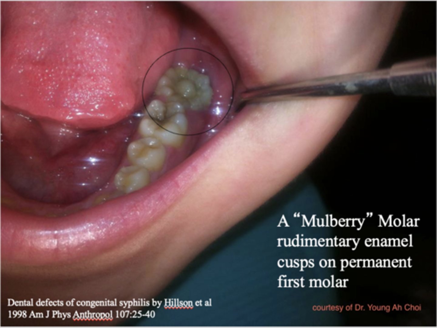 <p>congenital syphilis</p>