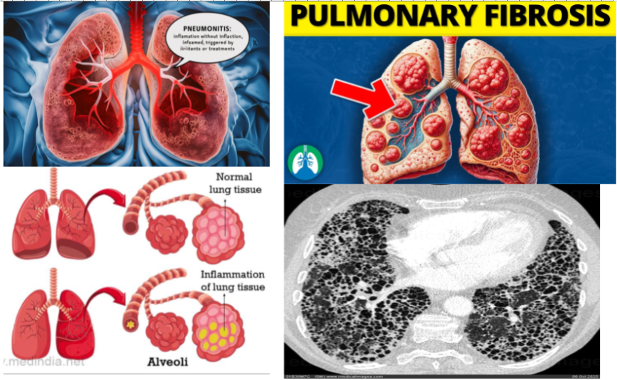 <ol><li><p>Radiation Pneumonitis</p></li><li><p>Lung Fibrosis</p></li><li><p>Chronic, dry, non-productive cough</p></li><li><p>Dyspnea&nbsp;</p></li></ol><p></p>