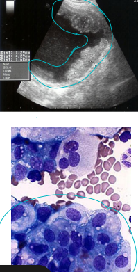 <p>Bladder tumors</p>