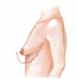 <p>Severe breast constriction with minimal breast base </p>