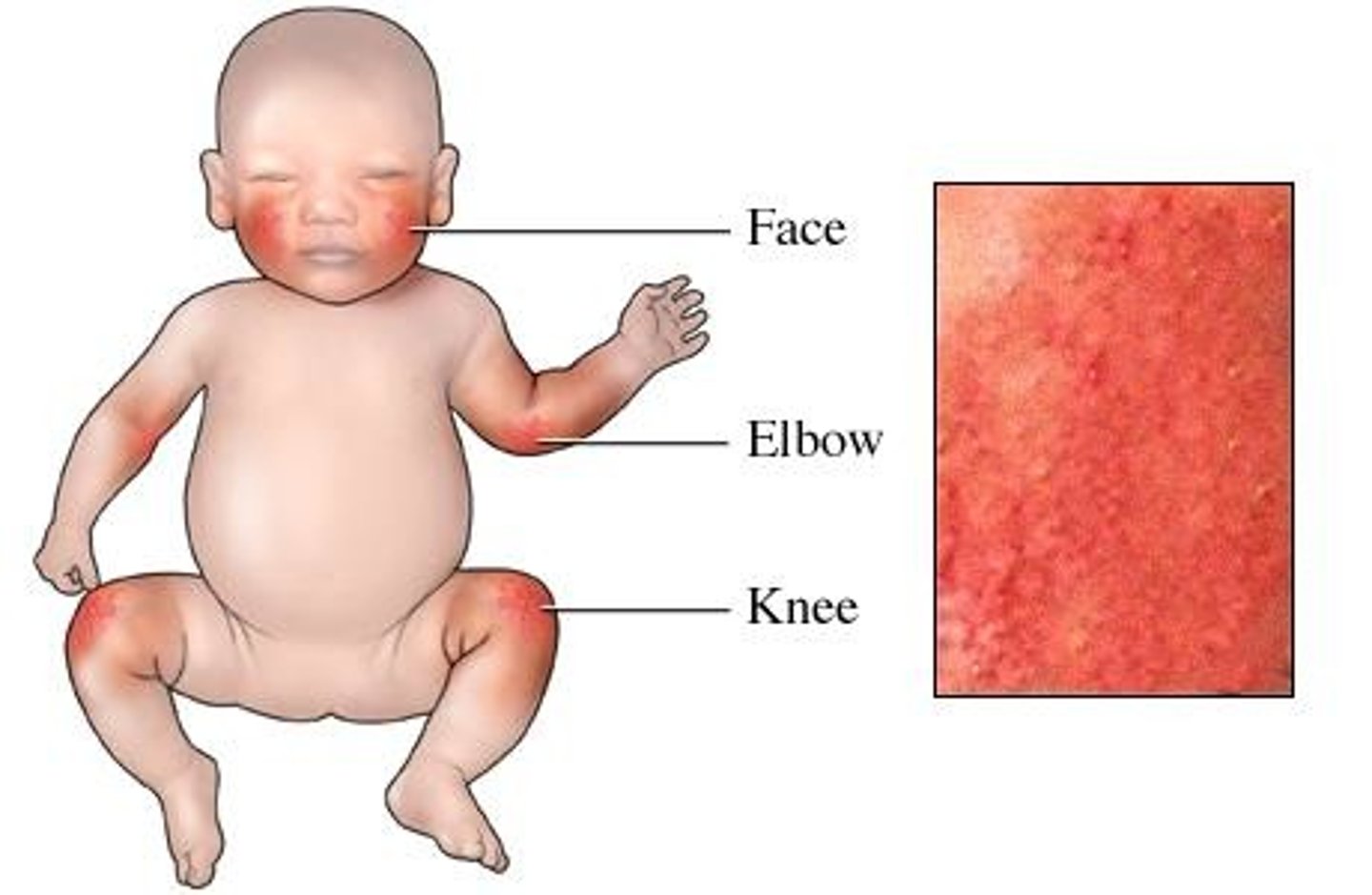 <p>inflammatory condition of the skin</p>