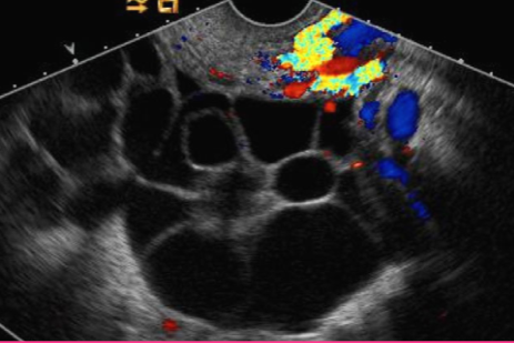 <p>What is the sonographic appearance of a Theca-Lutein cyst?</p>