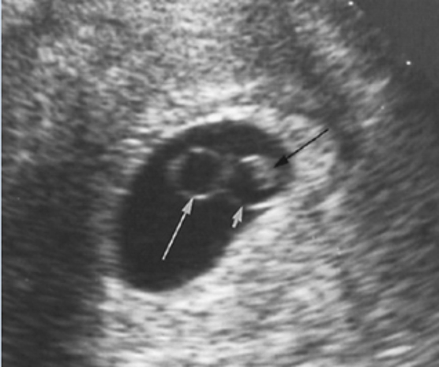 <p>where air enters from an opening in the internal airways</p><p>1. Primary spontaneous pneumothorax: usually mild</p><p>-occurs when a small air blister (bleb) on the top of the lung ruptures</p><p>- blebs are caused by a weakness in the lung tissue</p><p>-occurs in people with no hx of lung disease. they are usually tall, thin men</p><p>2. Secondary spontaneous pneumothorax:</p><p>-more severe and even life-threatening</p><p>-develops in people with preexisting lung disease</p><p>-weakened lung tissue ruptures</p>