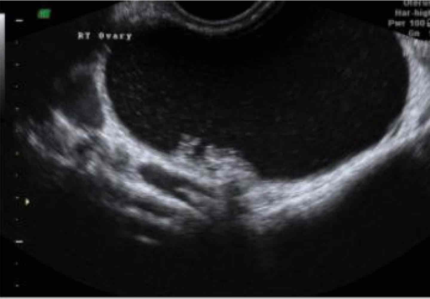 <p>(most common malignancy)</p><p>cystic with septations and papillary projections </p>