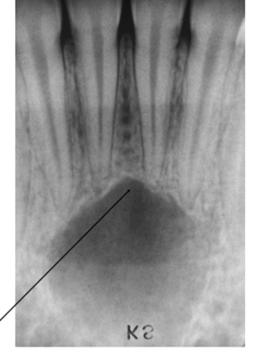 <p>What is a clinical manifestation associated with simple bone cysts?</p>