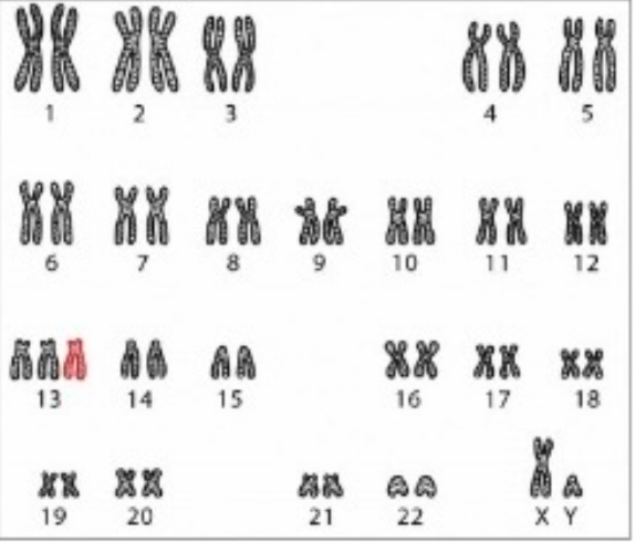 <p>Question 4: Based on the image analysis, do you think that the baby would have any chromosome abnormality?</p><p>a. Yes, he would have a trisomy 13</p><p>b. Yes, he would have a trisomy 21</p><p>c. Yes, he would have monosomy</p><p>d. No, he would be a healthy baby</p>