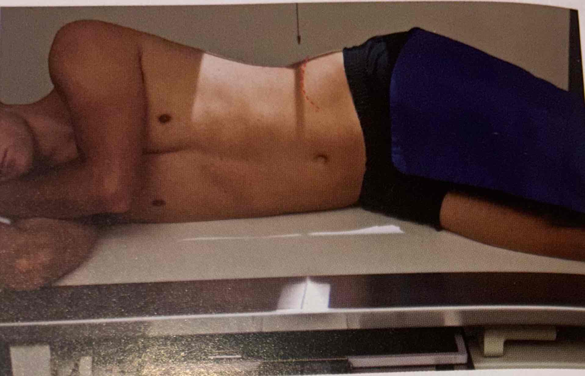 <p>Clinical indication for a lateral abdomen</p>