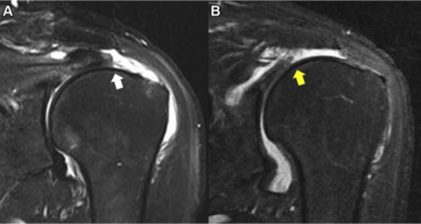 <p>What are these images depicting w/ the rotator cuff?</p>