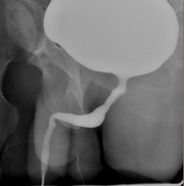 <p>1)contrast procedure performed?</p><p>2)contrast media used?</p><p>3)What abnormality will they look for when performing images during the fluoroscopic portion of the examination?</p><p></p>