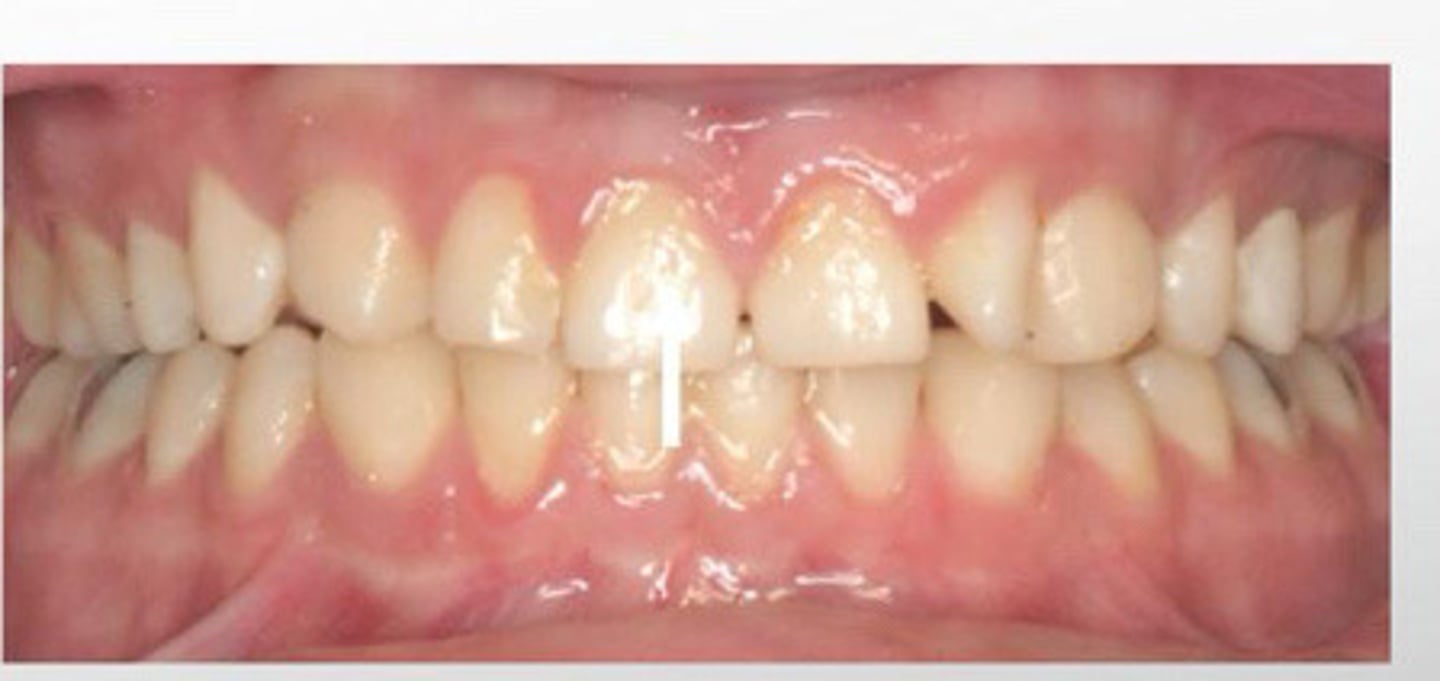 <p>anterior teeth, closest to the lips</p>