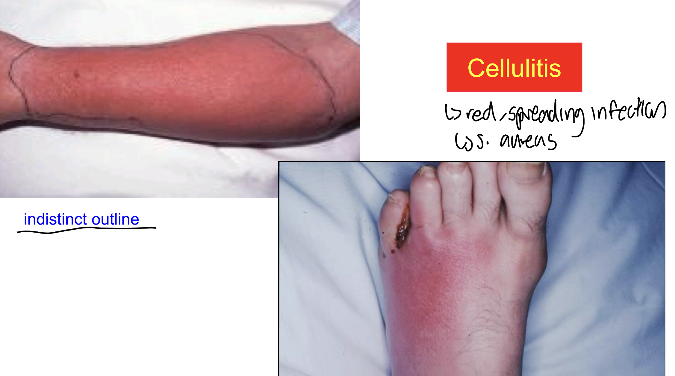 <p><strong>True, it is an infection of the skin and underlying tissues caused by Staphylococcus aureus, often displayed as a red, spreading infection with an indistinct outline</strong></p>