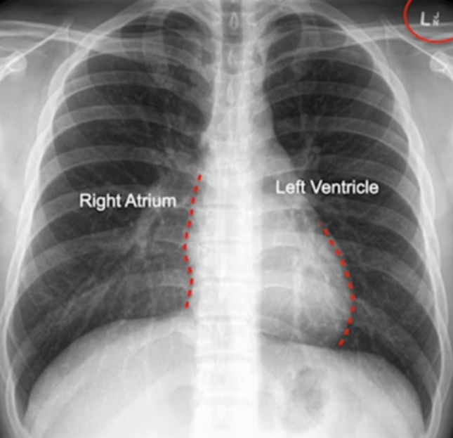 <p>If the delineation is disrupted on the right what is the expected diagnosis?</p>