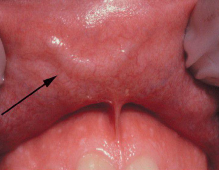 <p>upper lip vascular anomaly, BLEEDING RISK </p>