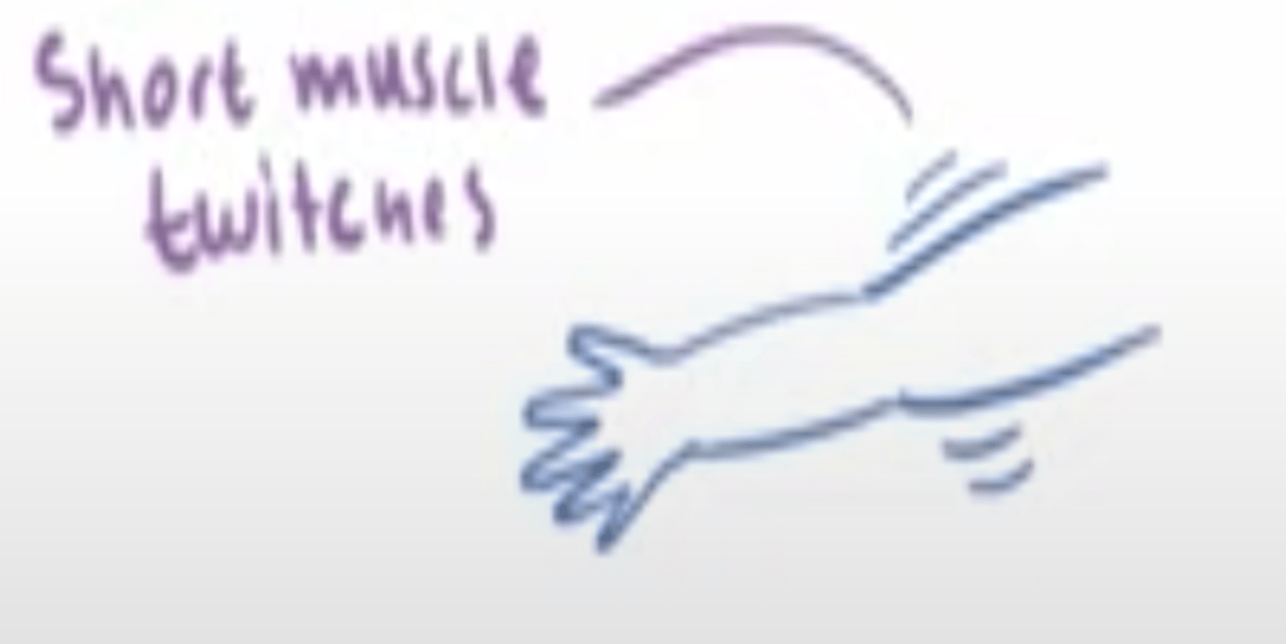<p>Brief muscle contractions can occur singly or in clusters</p><p>Arms are affected</p><p>Consciousness is NOT impaired</p>