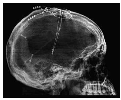 * deep brain stimulation 
* has application in treating psychiatric, neurological, and psychological conditions 