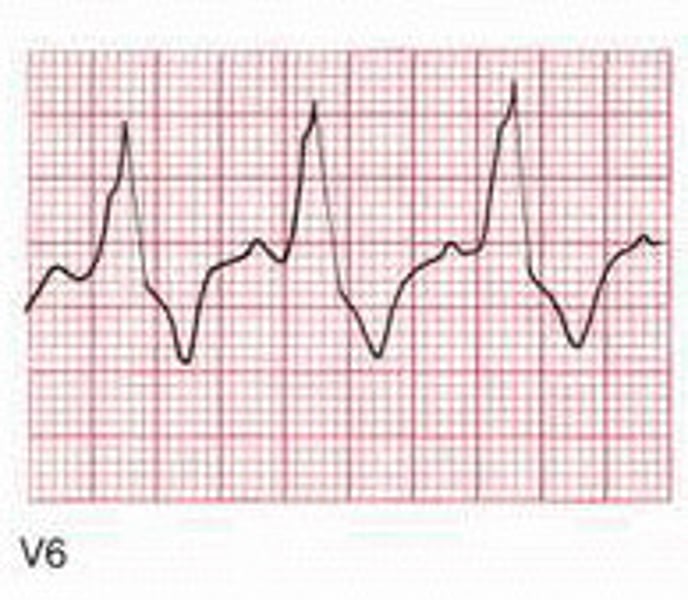 <p>impulse is delayed or blocked within the bundle branches of the normal conduction pathway</p>