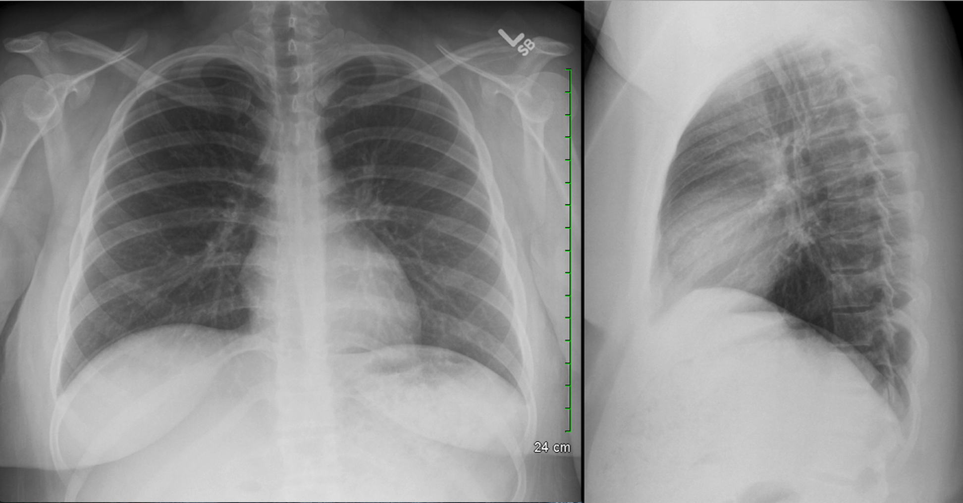 <p>Normal CXR (PA & Lateral) </p>