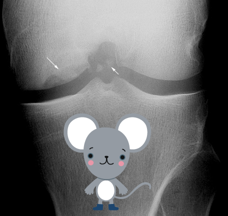 <ul><li><p>Idiopathic, traumatic</p></li><li><p>Small fragments of subchondral bone necrotize if displaced, undisplaced frags may reattach and revascularize</p></li><li><p>frags are known as <strong>“joint mice”</strong></p></li><li><p>high incidence in medial condyle 75%</p></li></ul><p></p>