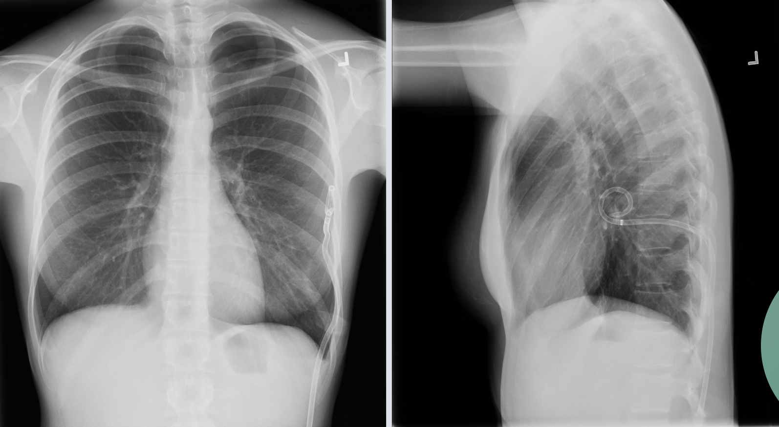 <p>this is pneumothorax, what is the treatment in this RA</p>