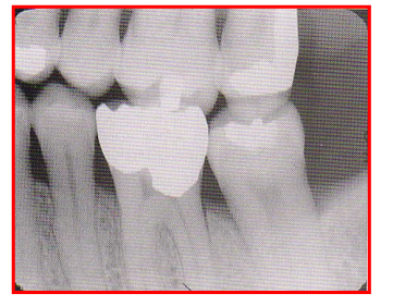 <ul><li><p>BW image appears distorted, you can see occlusal surfaces slightly. </p><ul><li><p>Reason: Negative vertical angulation used </p></li></ul></li><li><p>Fix: +10 deg vertical angulation when taking bisecting BW exposures → PID positioned downwards </p><ul><li><p>compensates for the slight tilt of maxillary teeth and lingual bend of upper half of the film </p></li></ul></li></ul><p></p>
