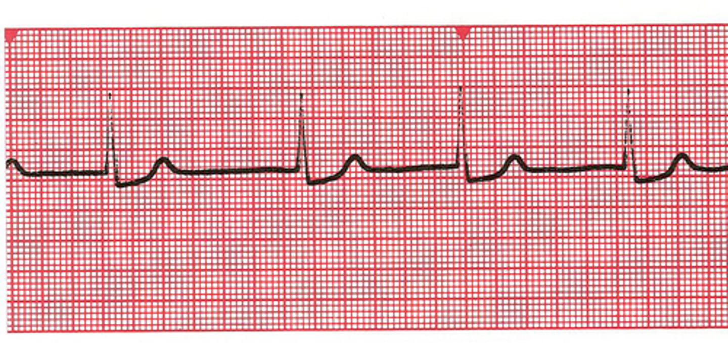 <p>Originates in an AV junction automaticity focus (rate 40-60 bpm); no p wave or an inverted p wave but a normal QRS</p>