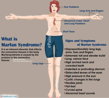 <p>What does this refer to</p><ul><li><p>Marfan’s syndrome</p></li></ul><p></p>