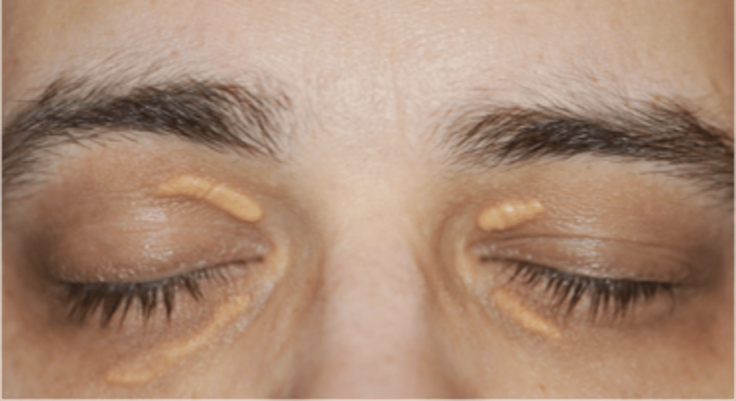 <p>name the eyelid abnormality</p>