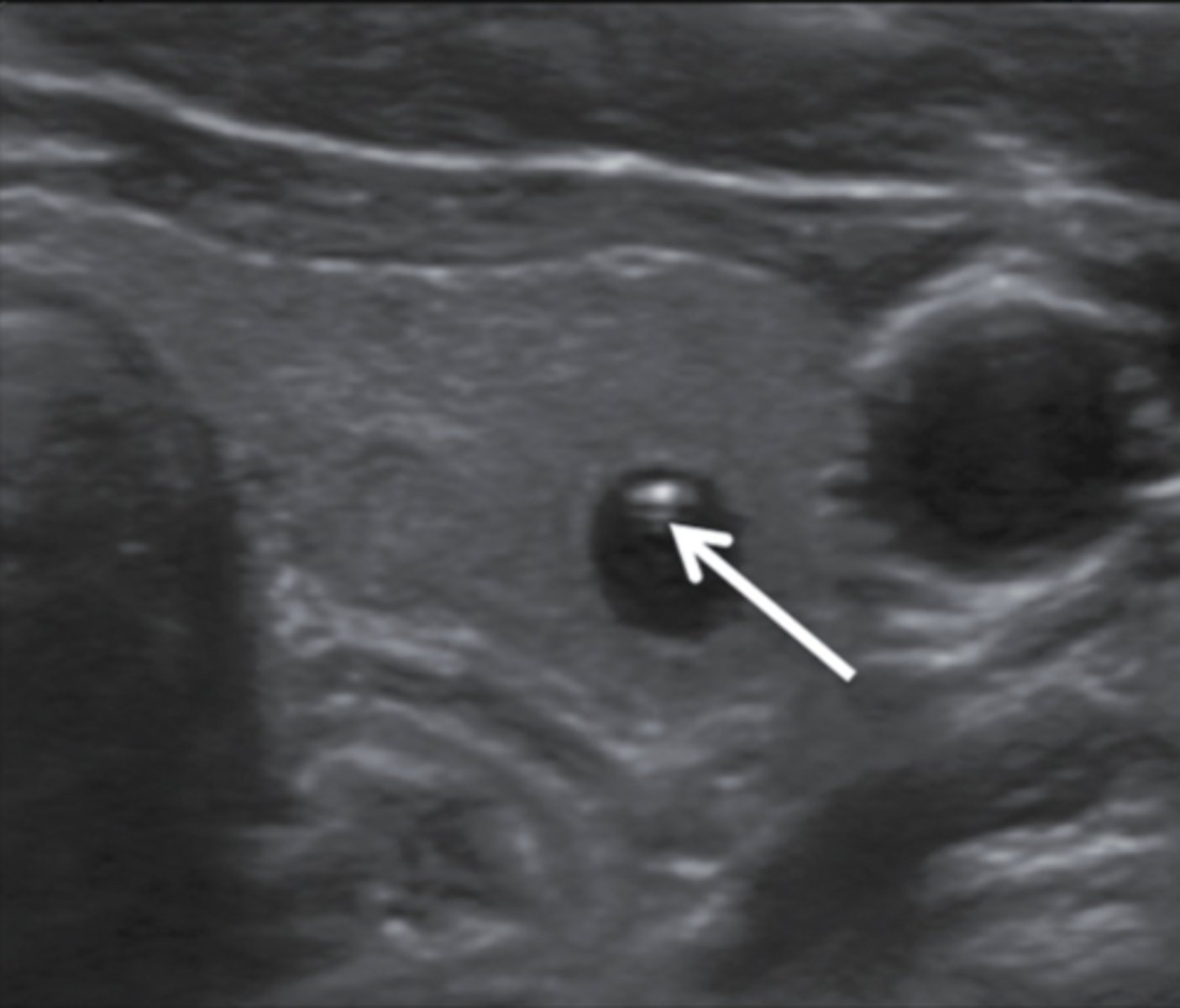 <p>a. Colloid cyst</p>