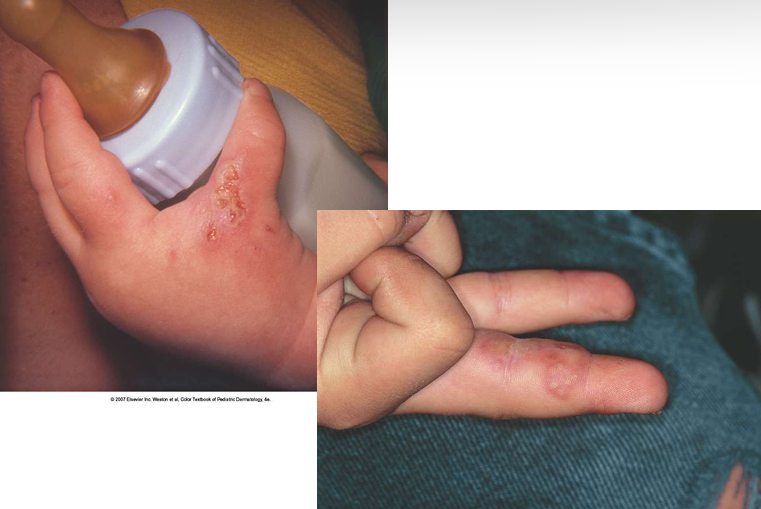 <p>Welke virale infectie / kenmerk zien we hier?</p>