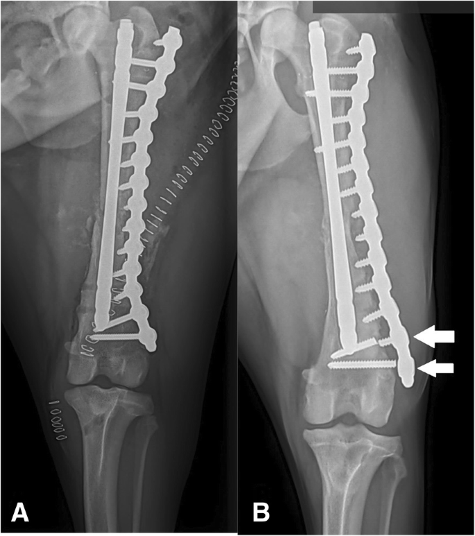 <p><strong><u>can be used temporarily in emergencies</u></strong> and on <strong><u>all fracture geometries. </u></strong>Can be used on<strong><u> both proximal and distal ends </u></strong>but require a large incision and has to be temporary because <strong><u>it can cause infection</u></strong></p>