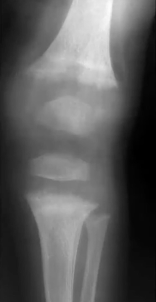 <p>What is this?</p><p>Ex. 6 mo-1 yo pt with Vit D Deficiency</p>