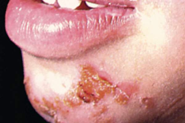 <ul><li><p><span style="line-height: inherit;">Impetigo is caused by streptococcus or staphylococcus aureus. A common characteristic of impetigo is the formation of crusty lesions and small vesicles around the nose and mouth (may often be across the entire face).</span></p></li><li><p><span style="line-height: inherit;">Honey-colored exudate is excreted from areas of impetigo.</span></p></li><li><p><span style="line-height: inherit;">The treatment includes oral antibiotics and possibly topical antibiotic cream.</span></p></li></ul><p></p>