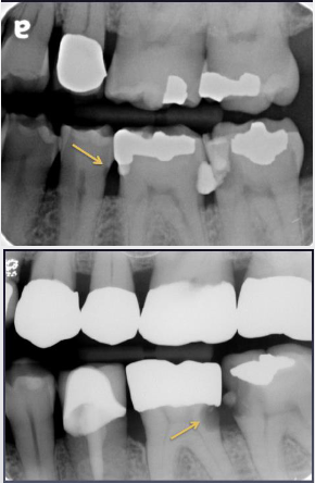 <p>What are root caries?</p>