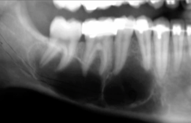 <p>teeth are vital and asymptomatic, diagnosis?</p>