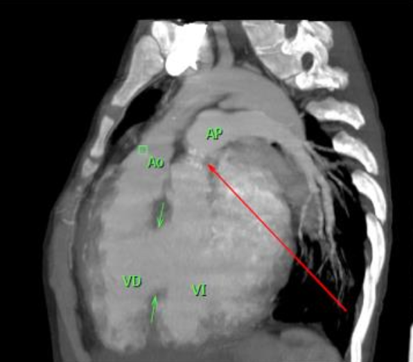 <p>El tabique troncoconal no sigue su curso espiralado y se forma en línea recta.</p><p>Imagen: Tomografía computarizada sagital oblicua. También se ve comunicación interventricular (verde) y estenosis de arteria pulmonar (rojo)</p>