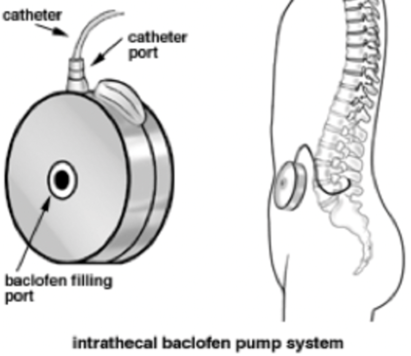 <p>Intrathecal Baclofen Pump</p>