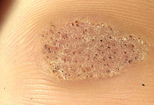 <ol><li><p>rough, raised bumps, often cauliflower-like appearance </p></li><li><p>wart seeds (small black dots) representing clotted blood vessels on the surface  </p></li></ol><p></p>